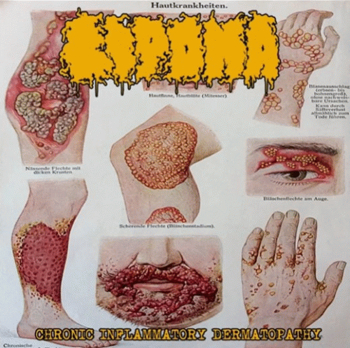 Lipoma : Chronic Inflammatory Dermatopathy